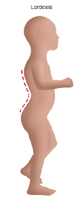 Haga clic en la imagen para ampliarla. Ilustración de un niño con lordosis