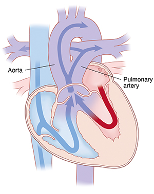 Truncus arteriosus. Four-chamber view of heart showing truncus arteriosus. Arrows indicate blood flowing from both ventricles to pulmonary artery and aorta.