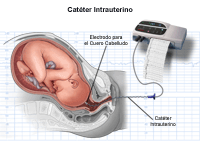 haga clic en la imagen para agrandar Ilustración del control interno de la frecuencia cardíaca fetal