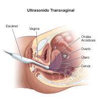 haga clic en la imagen para agrandar Ilustración del procedimiento de ultrasonido transvaginal