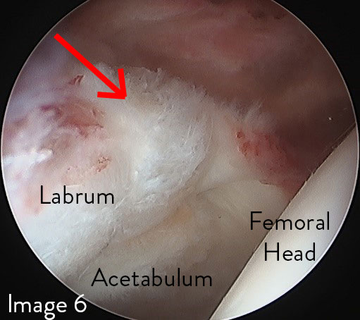 PAO Surgery 6