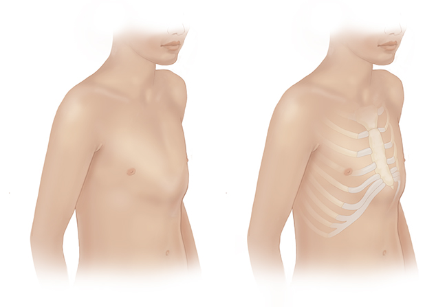 Custom Brace for Pectus Carinatum, also known as Pigeon Chest