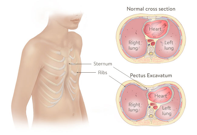 pectus excavatum surgery, what is pectus excavatum