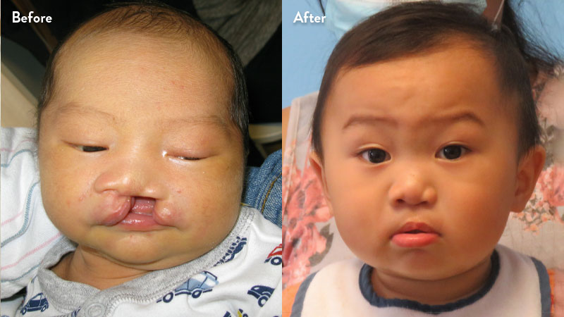 Before and after of young child with cleft lip