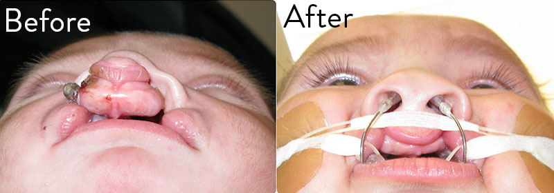 Patient 1 before and after nasal alveolar molding