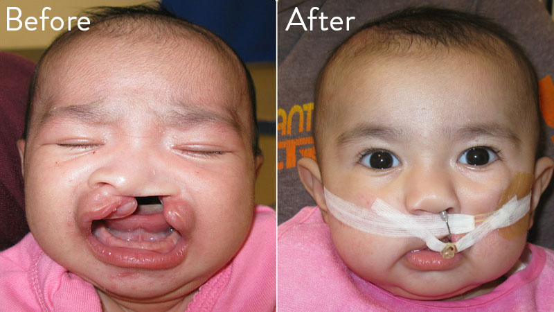 Patient 2 before and after nasal alveolar molding
