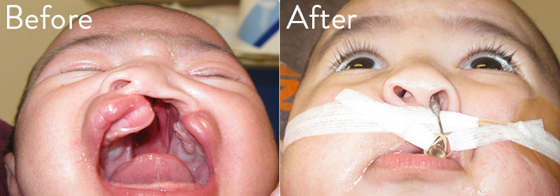 Patient 2 before and after nasal alveolar molding