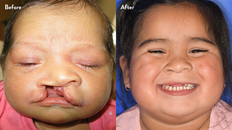 Before and after of girl with cleft lip