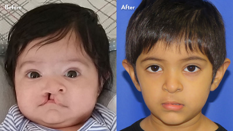 Before and after of young boy with cleft lip