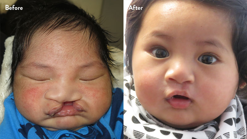Before and after of baby with cleft lip