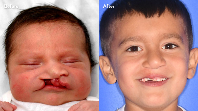 Before and after of boy with cleft lip