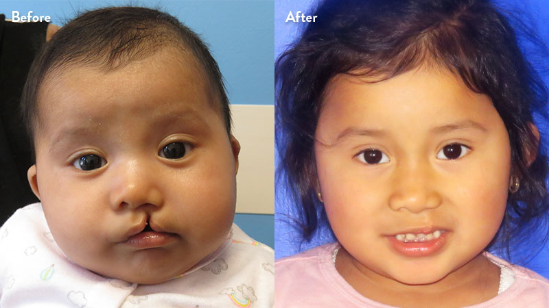 Before and after of girl with cleft lip
