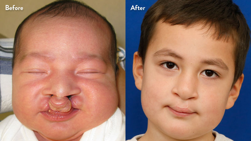 Before and after of boy with cleft lip