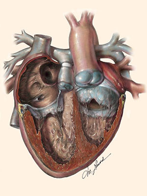 Pulmonary artery (PA) band diagram