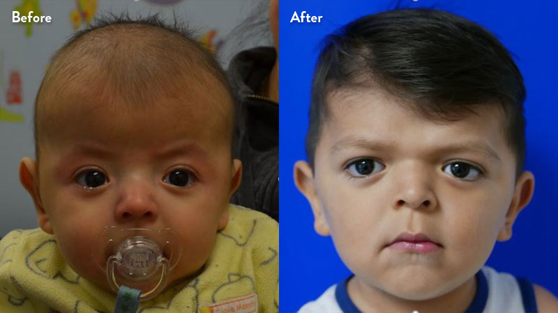 Patient frontal image of bilateral coronal craniosynostosis