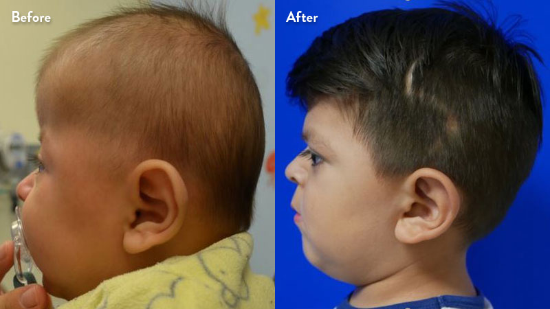 Patient profile of bilateral coronal craniosynostosis