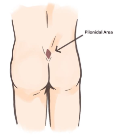 Pilonidal Disease graphic