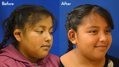 10 year old female with grade 2 microtia