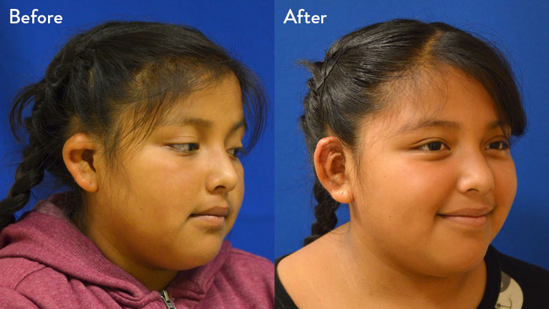 10 year old female with game 2 microtia 1