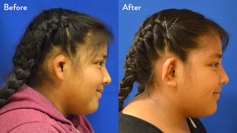 10 year old female with game 2 microtia 2