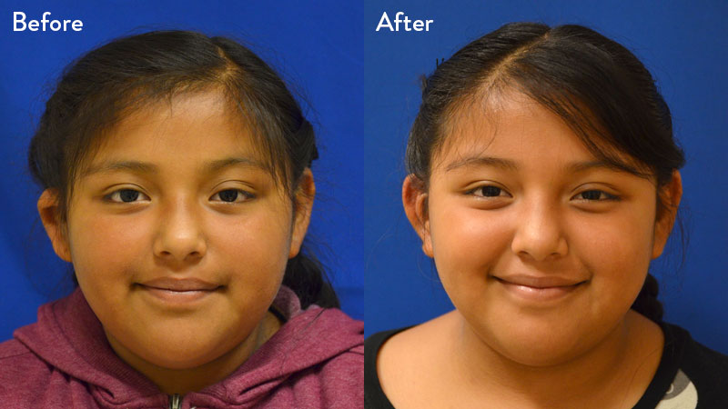 10 year old female with game 2 microtia 3