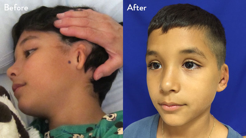 10 year old male with grade 2 microtia 1