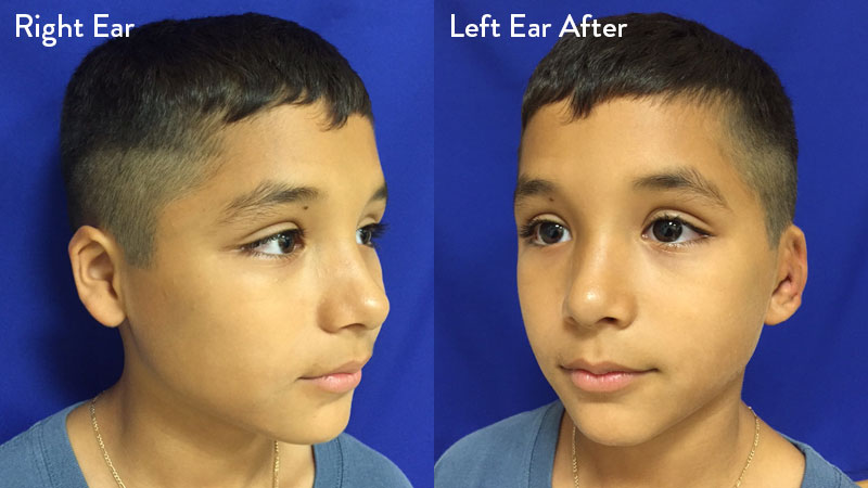 10 year old male with grade 2 microtia 1