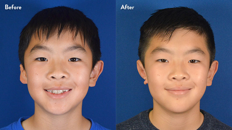 Front view, 10 year old male with grade 2-3 microtia