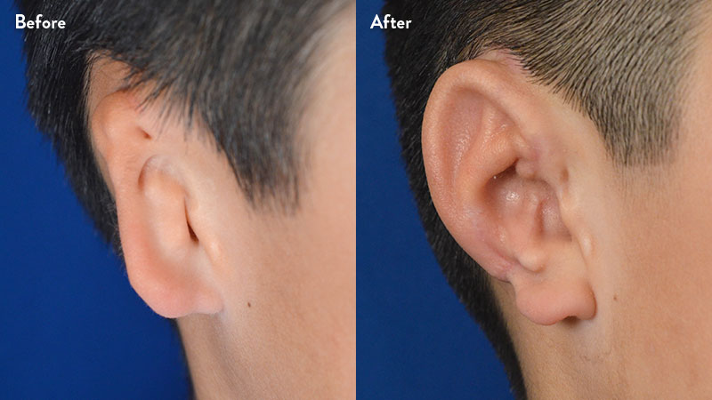 Right ear close up, 10 year old male with grade 2-3 microtia