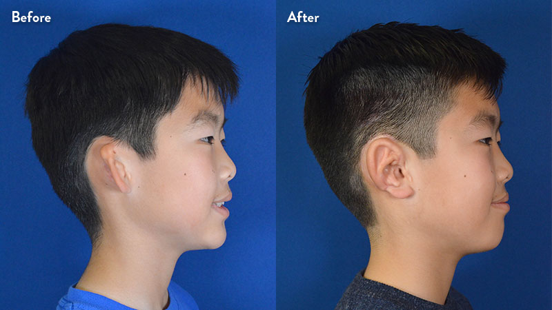 Profile view right ear, 10 year old male with grade 2-3 microtia