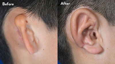 10 year old male with right grade 2-3 microtia
