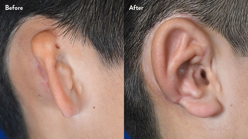 Profile view right ear close up, 10 year old male with grade 2-3 microtia