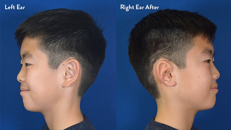 Profile view left and right ear, 10 year old male with grade 2-3 microtia