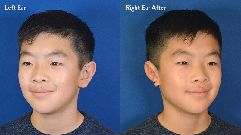 Left and right ear, 10 year old male with grade 2-3 microtia