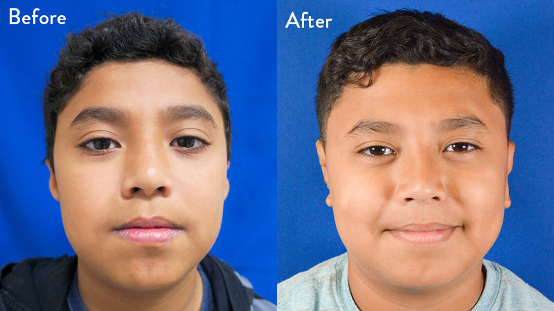 grade 3 microtia before and after