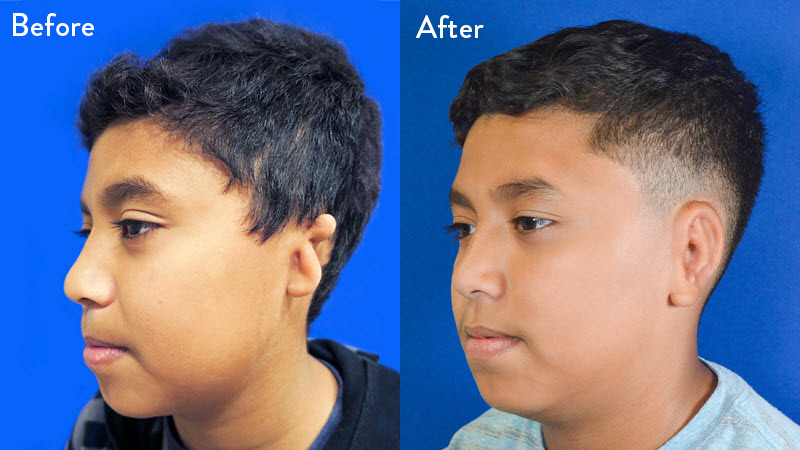 grade 3 microtia before and after