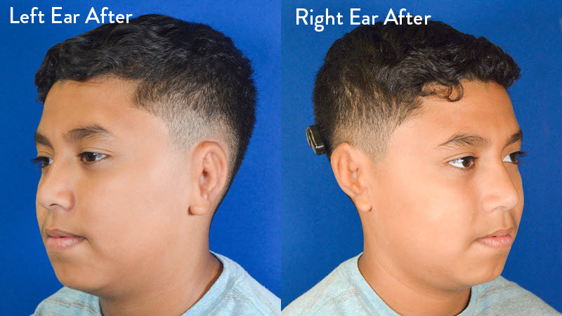 grade 3 microtia left and right ear after