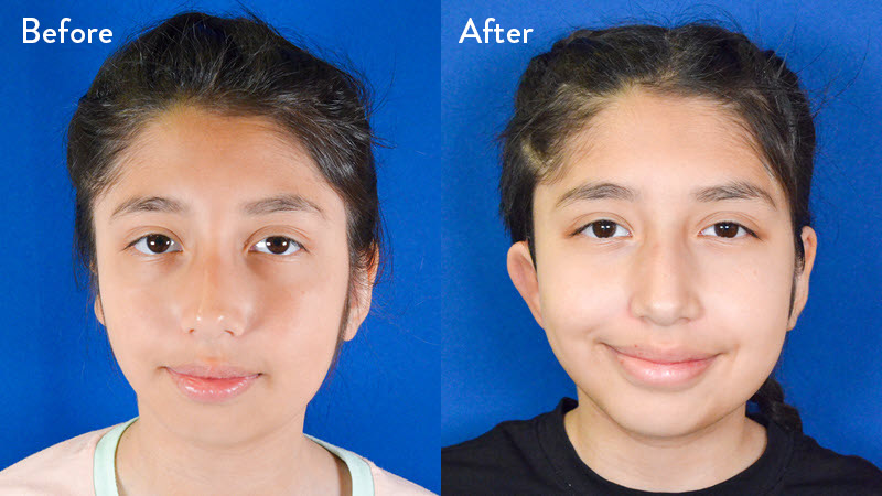 grade 3 microtia before and after