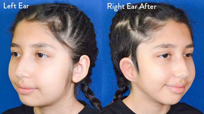 grade 3 microtia left and right ear after