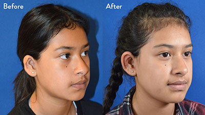 13 year old female with grade 2 microtia