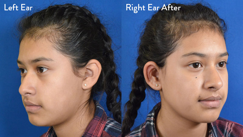 13-year-old Female with Grade 2 Microtia