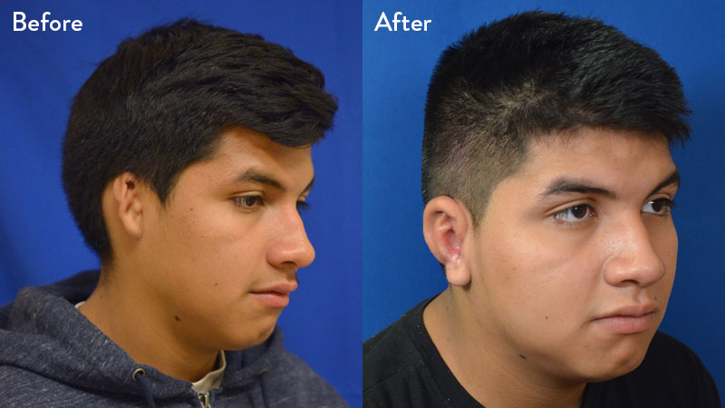 14-year-old-male with Grade 2-3 Microtia