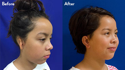 8 year old female with grade 3 microtia