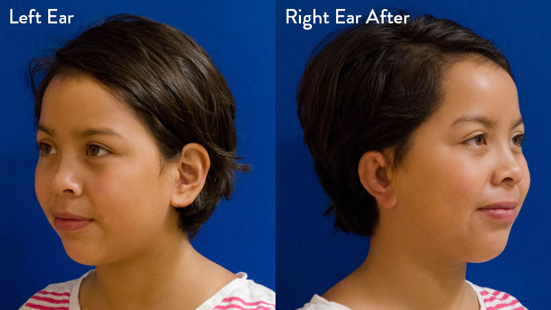 8 year old female with grade 3 microtia 3