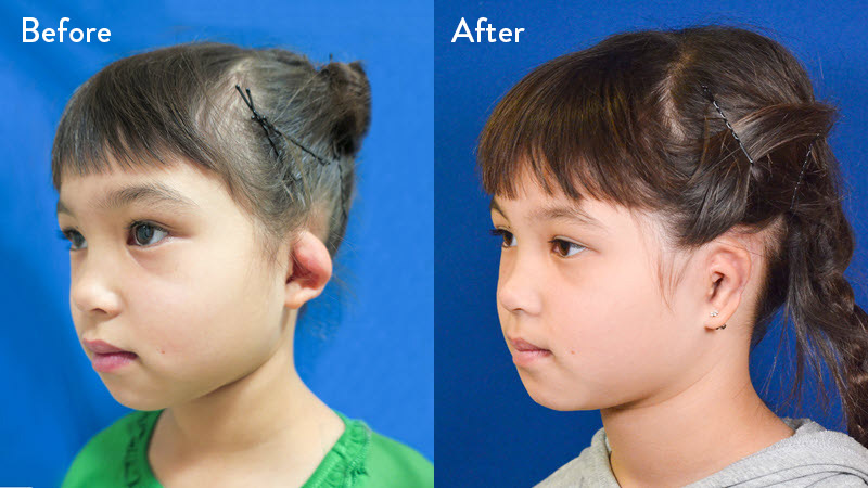 Grade 3 Microtia before and after close up