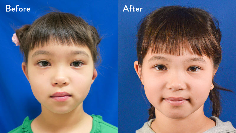 Grade 3 Microtia before and after