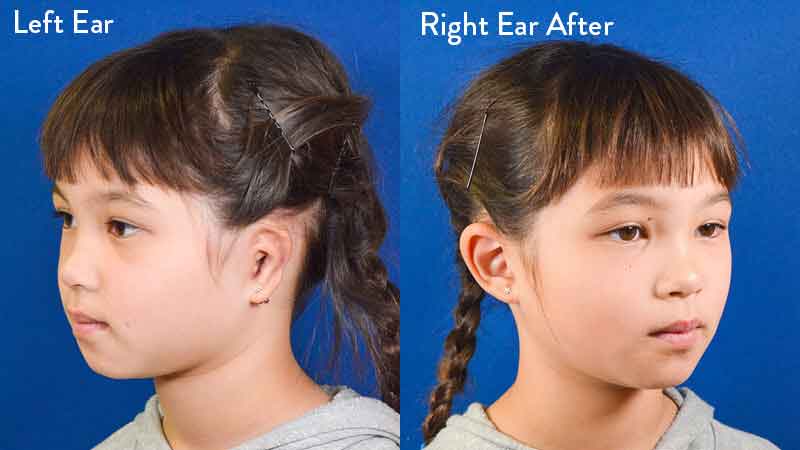 Grade 3 Microtia before and after
