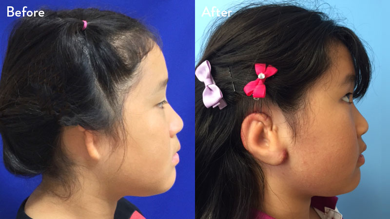 9 year old female with grade 3 microtia before and after rib cartilage graft repair 1