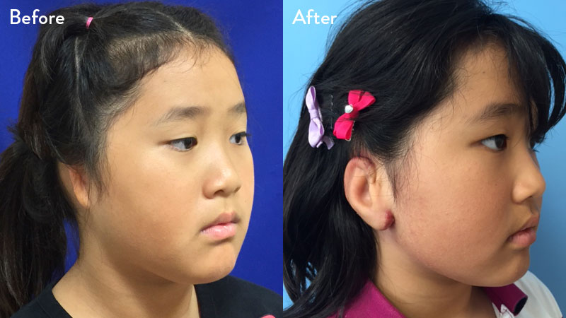 9 year old female with grade 3 microtia before and after rib cartilage graft repair 2