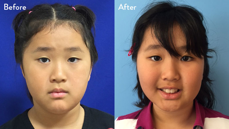 9 year old female with grade 3 microtia before and after rib cartilage graft repair 3